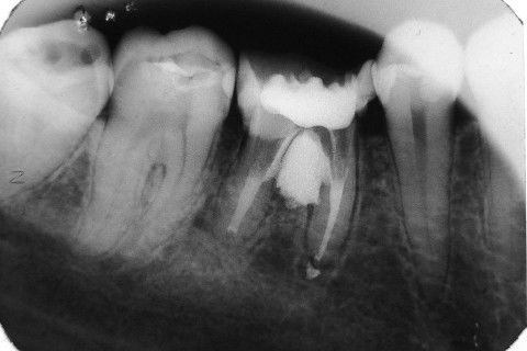 Retratamento de Canal, Tratamento de Perfuração, Restauração Provisória com Resina, Núcleo e Provisório.