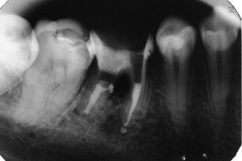 Retratamento de Canal, Tratamento de Perfuração, Restauração Provisória com Resina, Núcleo e Provisório.