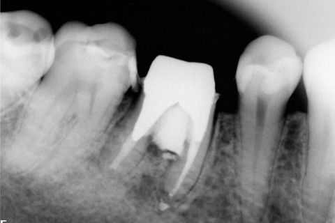 1º controle ( 1 mês após).