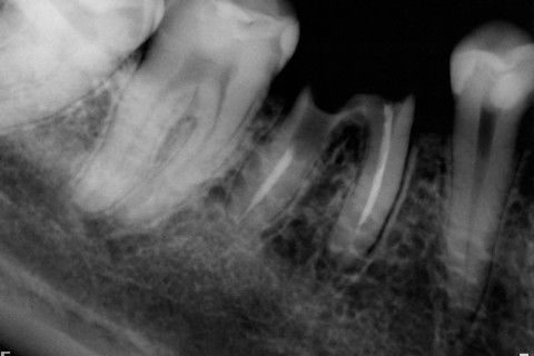 Retratamento de Canal, Tratamento de Perfuração, Restauração Provisória com Resina, Núcleo e Provisório.