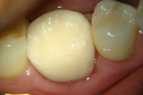 Retratamento de Canal, Tratamento de Perfuração, Restauração Provisória com Resina, Núcleo e Provisório.