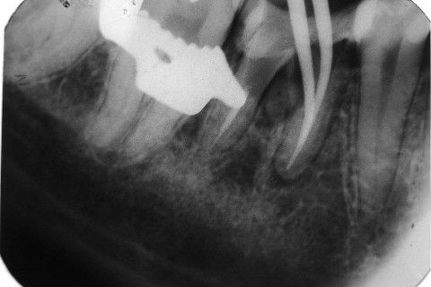 Retratamento de Canal, Tratamento de Perfuração, Restauração Provisória com Resina, Núcleo e Provisório.