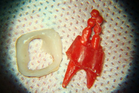 Retratamento de Canal, Tratamento de Perfuração, Restauração Provisória com Resina, Núcleo e Provisório.