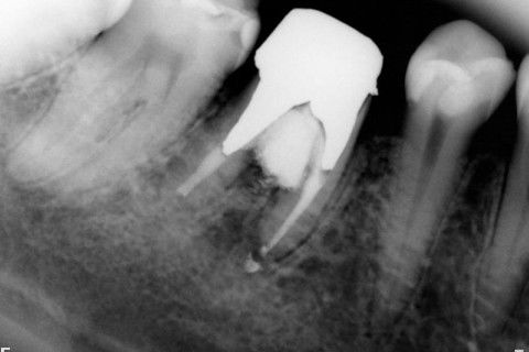 Retratamento de Canal, Tratamento de Perfuração, Restauração Provisória com Resina, Núcleo e Provisório.