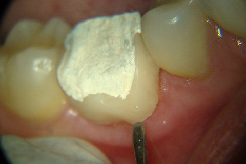 Retratamento de Canal, Tratamento de Perfuração, Restauração Provisória com Resina, Núcleo e Provisório.