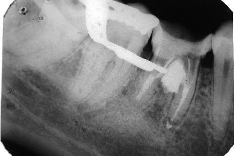 Retratamento de Canal, Tratamento de Perfuração, Restauração Provisória com Resina, Núcleo e Provisório.
