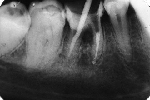Retratamento de Canal, Tratamento de Perfuração, Restauração Provisória com Resina, Núcleo e Provisório.