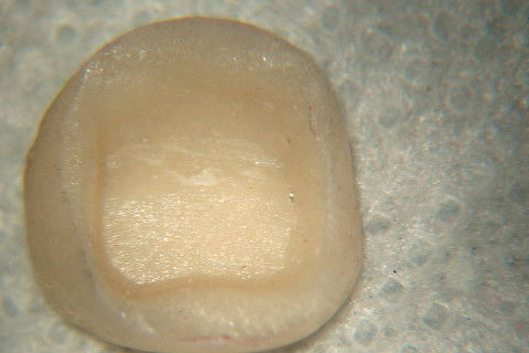 Retratamento de Canal, Tratamento de Perfuração, Restauração Provisória com Resina, Núcleo e Provisório.