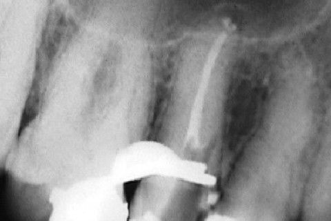 Calcificação Distrófica