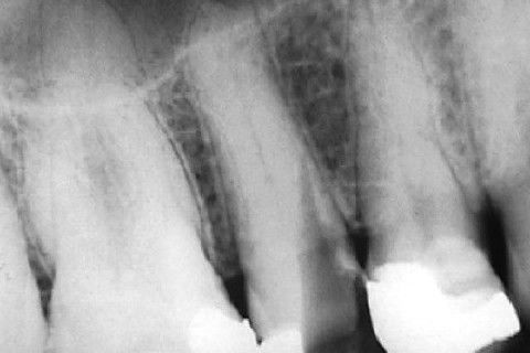 Calcificação Distrófica
