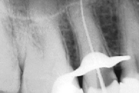 Calcificação Distrófica