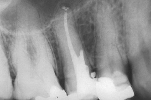 Calcificação Distrófica