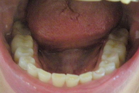 Tratamento Integrado Estético - Cirurgia, Periodontia, Clareamento, Resina, Endodontia e Prótese
