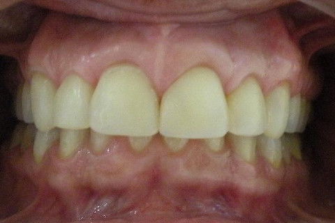 Tratamento Integrado Estético - Cirurgia, Periodontia, Clareamento, Resina, Endodontia e Prótese
