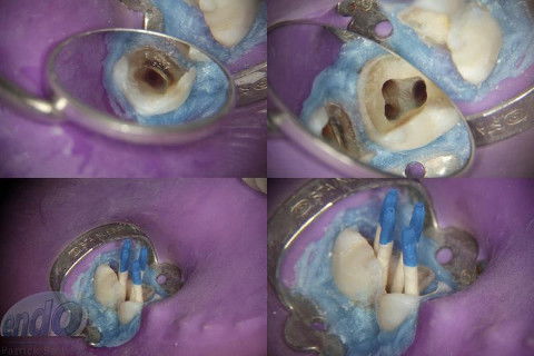 Tratamento Endodôntico dos Dentes 45 - 46 - 47