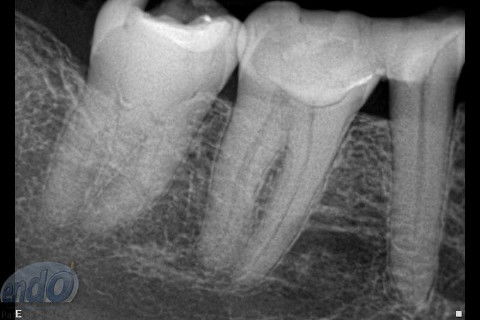 Tratamento Endodôntico dos Dentes 45 - 46 - 47