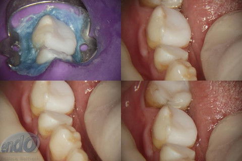 Tratamento Endodôntico dos Dentes 45 - 46 - 47