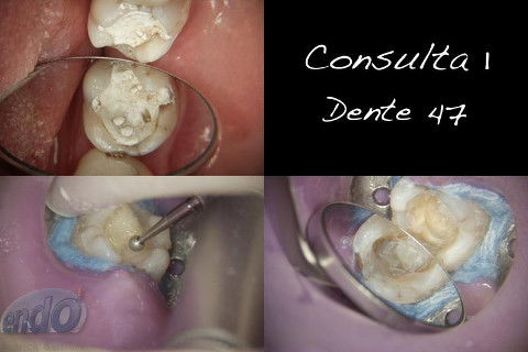 Tratamento Endodôntico dos Dentes 45 - 46 - 47
