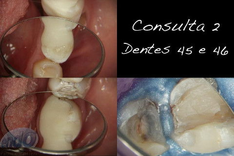 Tratamento Endodôntico dos Dentes 45 - 46 - 47