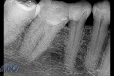 Tratamento Endodôntico dos Dentes 45 - 46 - 47