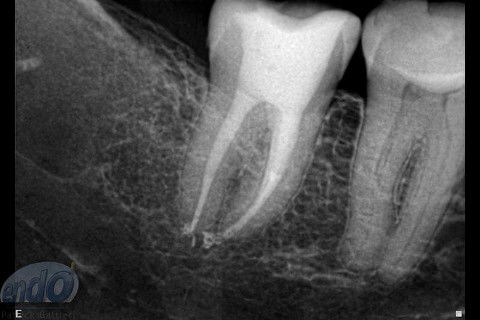 Tratamento Endodôntico dos Dentes 45 - 46 - 47