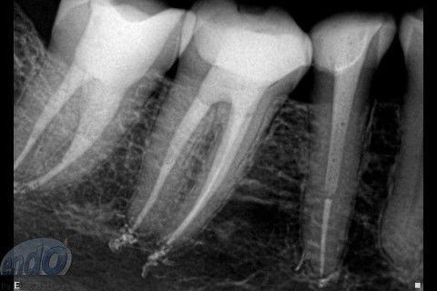 Tratamento Endodôntico dos Dentes 45 - 46 - 47