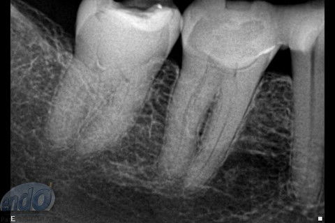 Tratamento Endodôntico dos Dentes 45 - 46 - 47