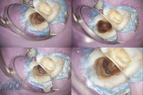 Tratamento Endodôntico dos Dentes 45 - 46 - 47