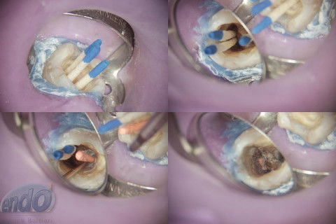 Tratamento Endodôntico dos Dentes 45 - 46 - 47