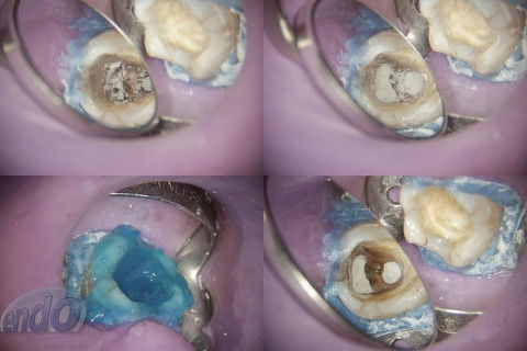 Tratamento Endodôntico dos Dentes 45 - 46 - 47