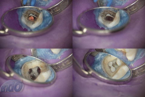 Tratamento Endodôntico dos Dentes 45 - 46 - 47