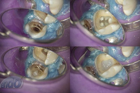 Tratamento Endodôntico dos Dentes 45 - 46 - 47