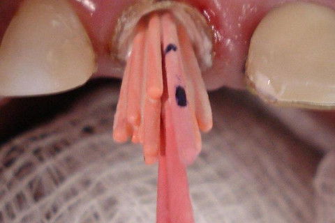 Complementação da obturação com cones acessórios