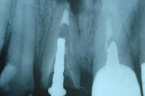 Aspecto final do tratamento endodôntico