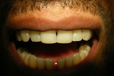 Abertura ao fim do tratamento ressaltando o contorno final dos bordos incisais sobre o fundo escuro da boca. Mais um paciente satisfeito!