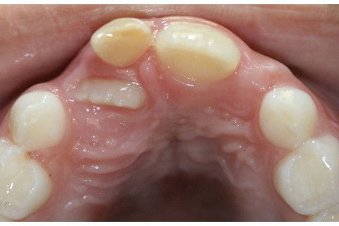 Retenção Prolongada de Dente Decíduo em Decorrência de Traumatismo