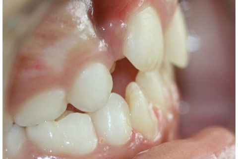 Retenção Prolongada de Dente Decíduo em Decorrência de Traumatismo