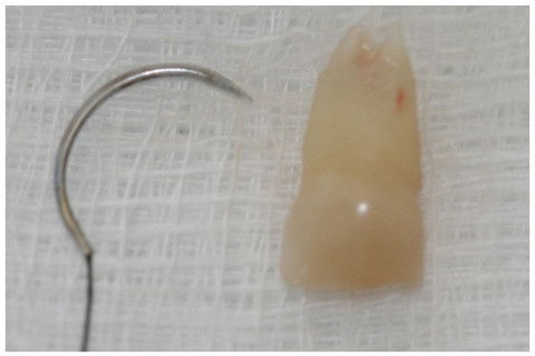 Retenção Prolongada de Dente Decíduo em Decorrência de Traumatismo