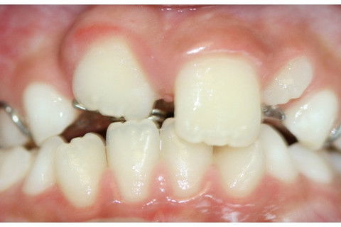 Retenção Prolongada de Dente Decíduo em Decorrência de Traumatismo