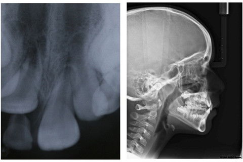 Retenção Prolongada de Dente Decíduo em Decorrência de Traumatismo