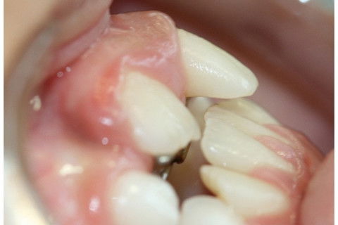 Retenção Prolongada de Dente Decíduo em Decorrência de Traumatismo