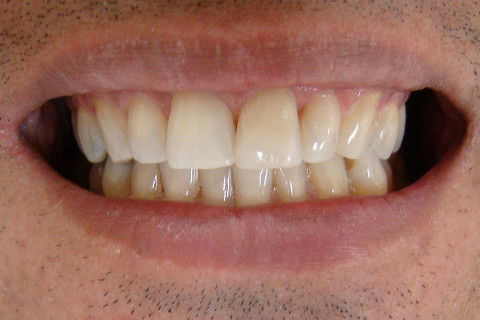 Restauração Estética de Dente Anterior (Classe Iv)