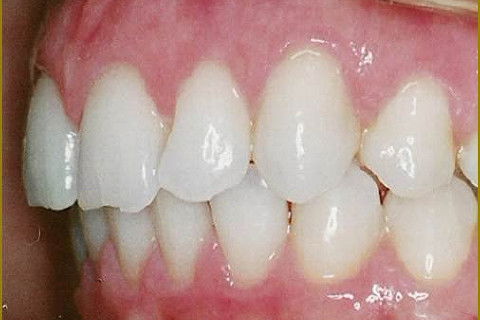 Clareamento Dental Caseiro