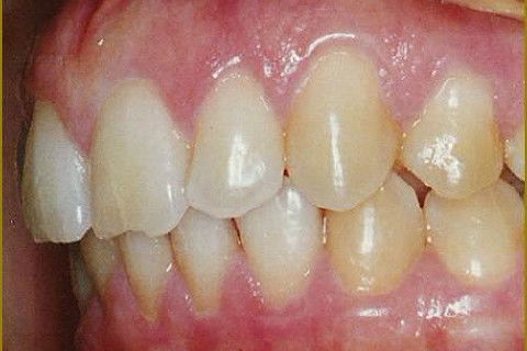 Clareamento Dental Caseiro