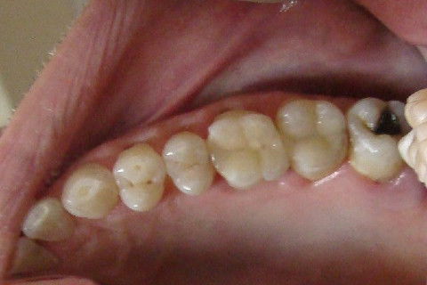 Restaurações em Resina Composta.