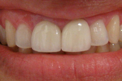 Coroa em Cerâmica Livre de Metal (In-Ceran).