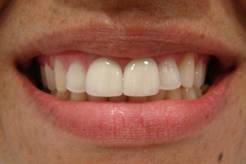 Coroa em Cerâmica Livre de Metal (In-Ceran).