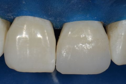 Confecção de Restauração em Resina Utilizando a Matriz Brb