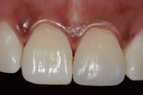 Confecção de Restauração em Resina Utilizando a Matriz Brb