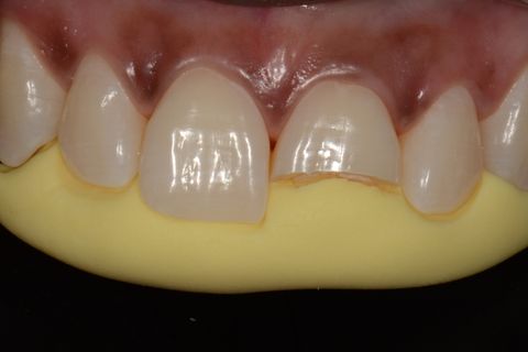 Confecção de Restauração em Resina Utilizando a Matriz Brb